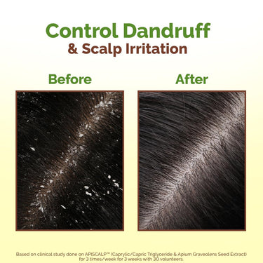 Mamaearth Lemon Anti-Dandruff Hair Oil for Flaky Scalp 100ml|Scalp Irritation Relief|Nourishes Scalp & Hair|Contains Lemon, Ginger, Apiscalp (Clinically Proven), Svetakutaja Oil, Neem, Salicylic Acid